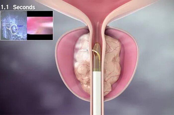 prostata terapia vapor reproducao redes sociais