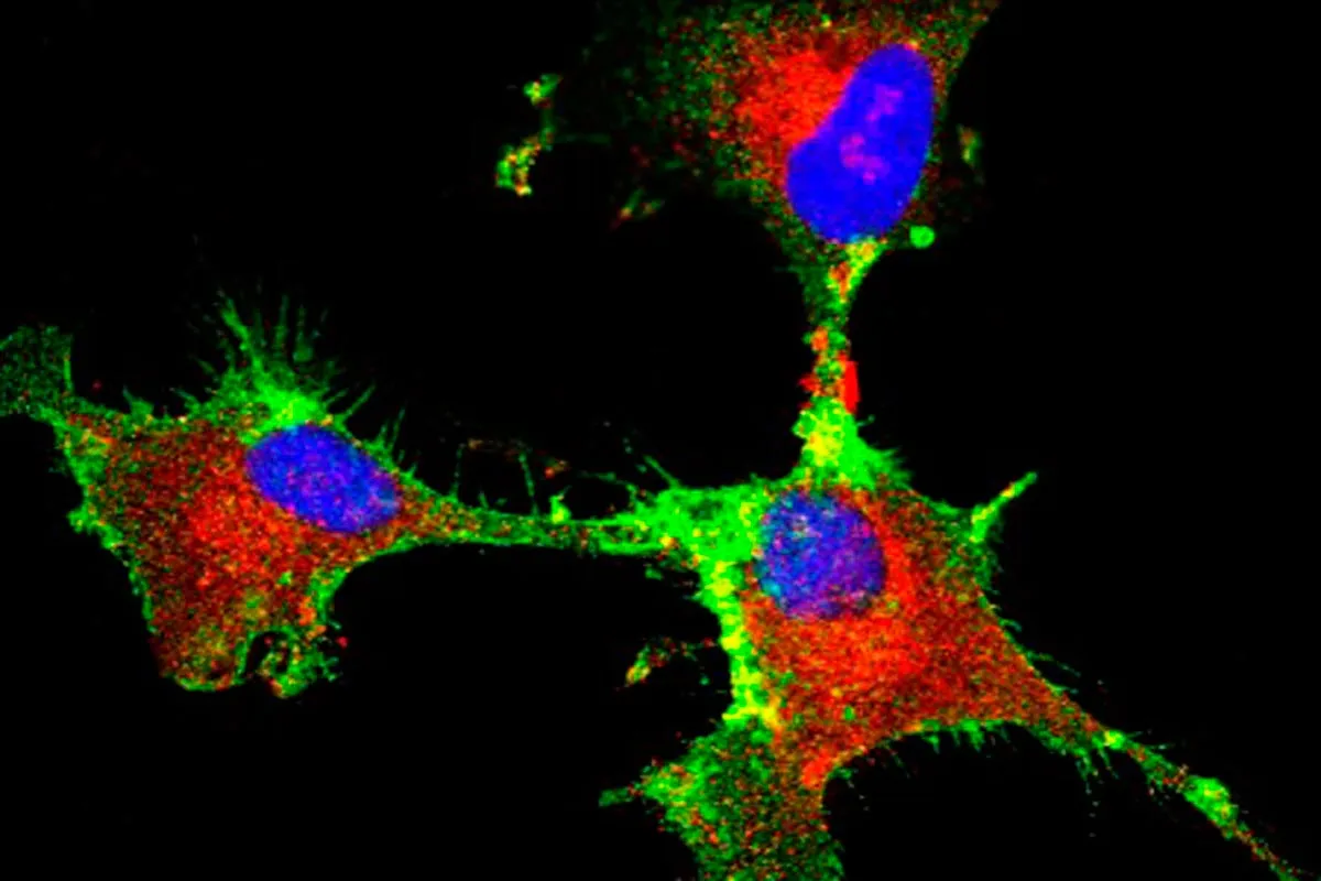 Estudo revela proteína-chave para a progressão de tipo de tumor cerebral