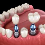 AO VIVO: notícias, doença inflamatória intestinal, implantes dentários e mães empreendedoras: acompanhe a Tribuna Transamérica 2 implante dentario foto iStock