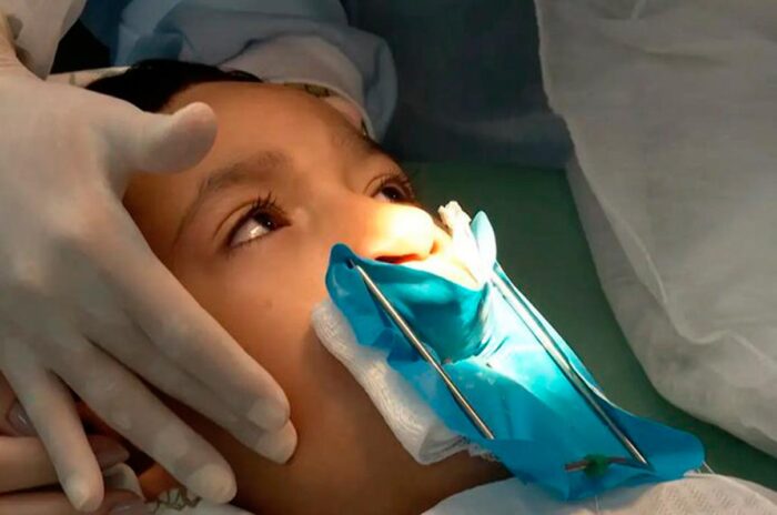 Lábio leporino: SUS passa a oferecer cirurgia e profissionais de saúde para pacientes 1 labio leporino cirurgia reconstrutiva foto reproducao tv brasil