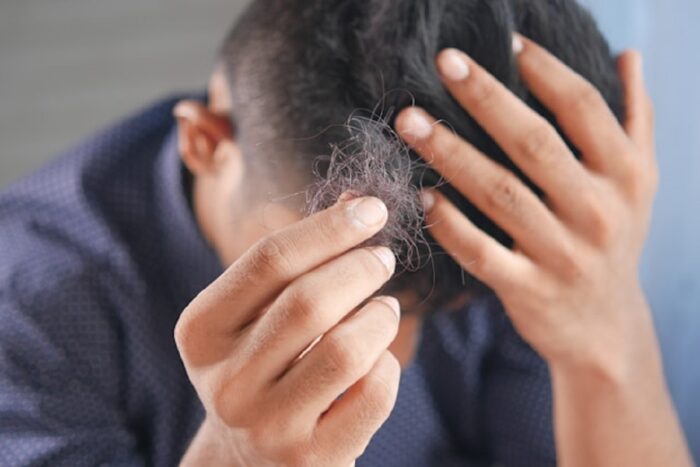 Alopecia areata: impacto mental supera gravidade clínica da doença, aponta estudo 1 alopecia areata