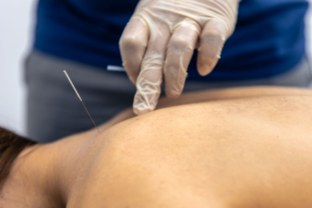 Acupuntura passa a ter exercício profissional regulamentado no Brasil 1 Acupuntura passa a ter exercício profissional regulamentado no Brasil