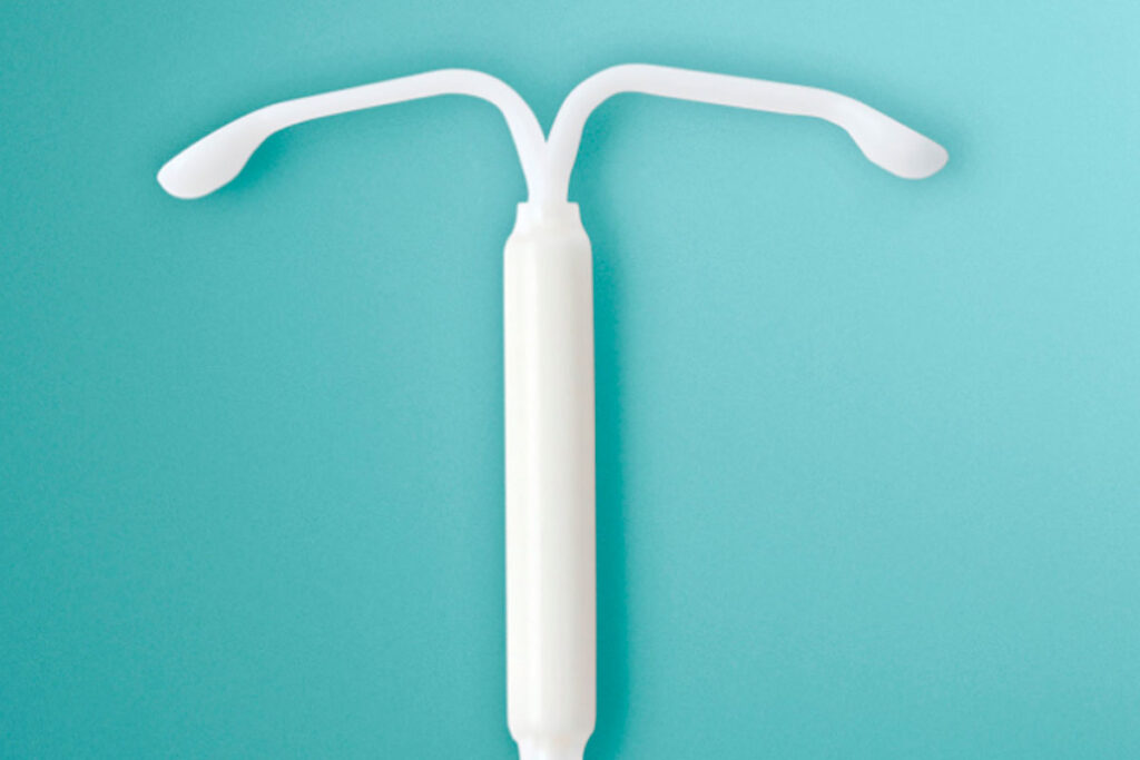 Existe relação entre o DIU hormonal e o aumento do risco de câncer de mama? 1 diu