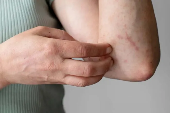 Relação entre alergia aos ácaros e reações aos anti-inflamatórios é explicada por pesquisadores