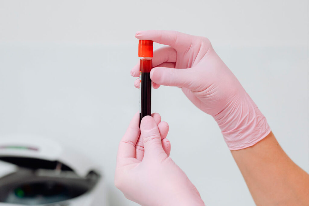 Exame de sangue conhecido como 'biópsia líquida' ajuda a identificar 4 vezes mais casos de câncer, diz estudo 1 exame de sangue biopsia liquida foto pexels