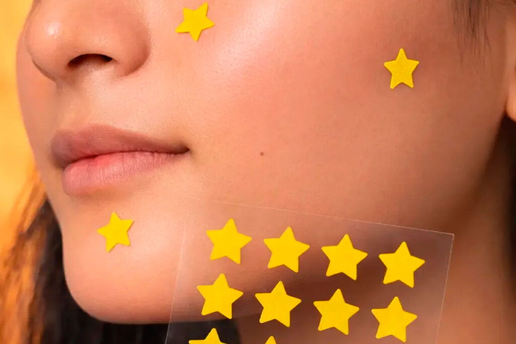 Adesivo para espinha realmente funciona? Dermatologistas explicam 1 adesivo espinha reproducao web