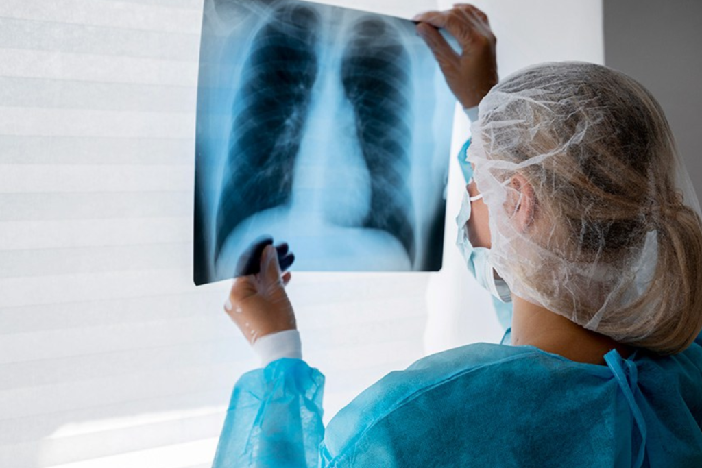 Quase 90% dos casos de câncer de pulmão chegam ao SUS em estágio avançado 1 cancer de pulmao